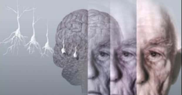 Билл Гейтс инвестировал $30 млн в изучение болезни Альцгеймера