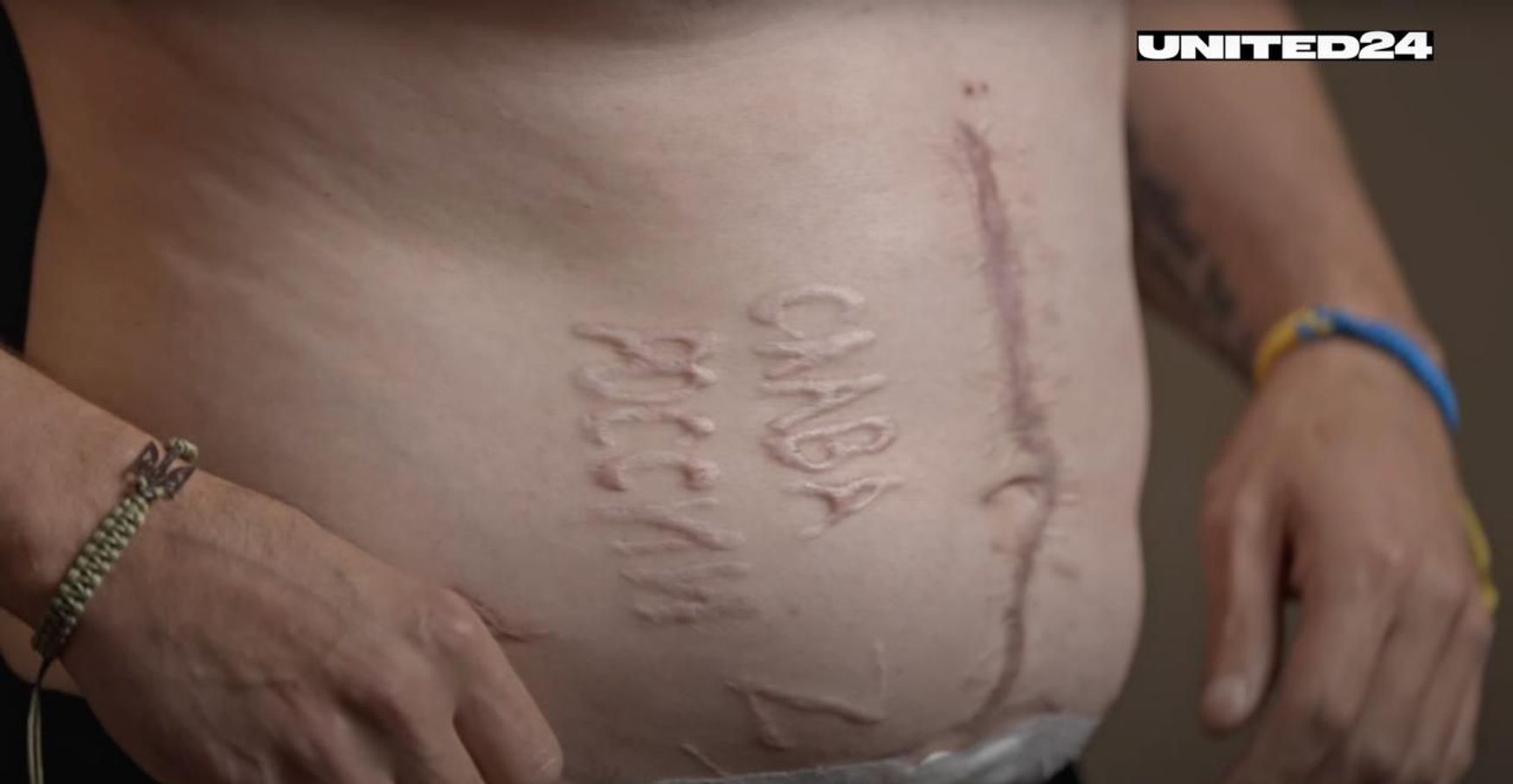The inscriptions “Glory to Russia” (“Slava Rossii”) along with the pro-war “Z” symbol were burned onto Ukrainian POW Andrii Pereverzev’s skin while he was unconscious and under anesthesia